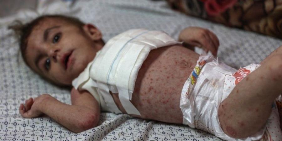 انتشار أمراض جلدية خطرة بين الأطفال في قطاع غزة - AARC مصر